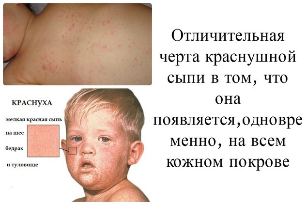 Сыпь при краснухе