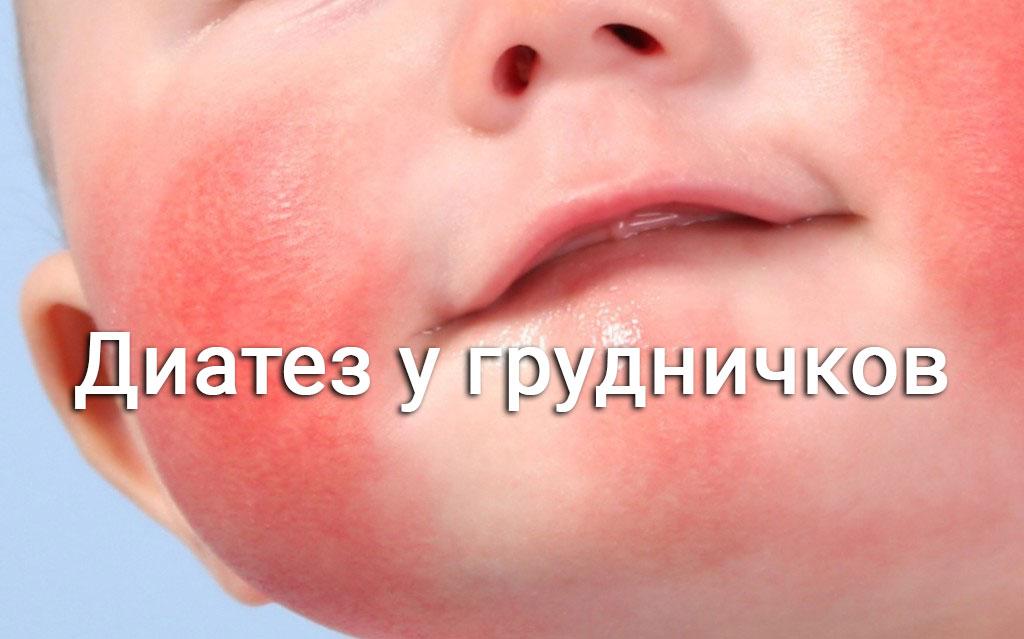 диатез на щеках у грудничка