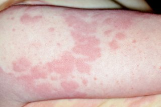 Picture of hives