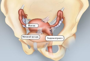 Признаки эндометриоза у женщин при хронической форме заболевания