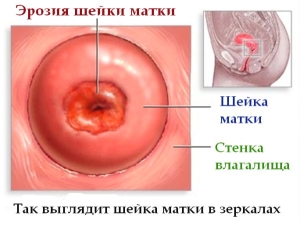 Выделения после прижигания эрозии шейки матки: методы лечения заболевания