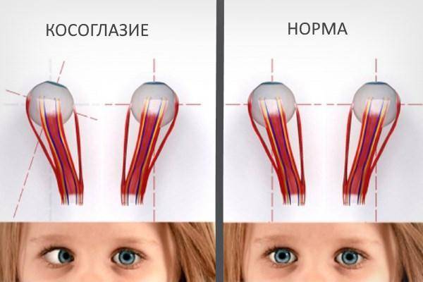 Косоглазие у новорожденных когда проходит: причины, лечение у детей, младенцев, сходящееся, без операции