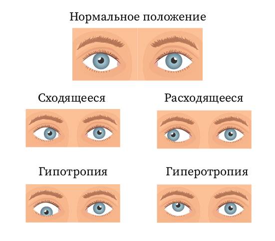 Косоглазие у новорожденных когда проходит: причины, лечение у детей, младенцев, сходящееся, без операции