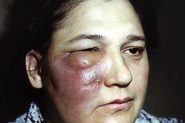 Гной на глазах после сна и сопли