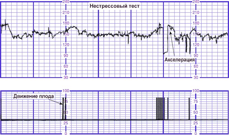 Результаты нестрессового теста КГТ плода