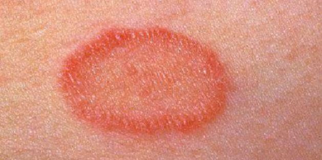Чем аллергия у ребёнка отличается от лишая
