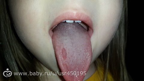Пятно на языке - Дети от 3 до 7 лет