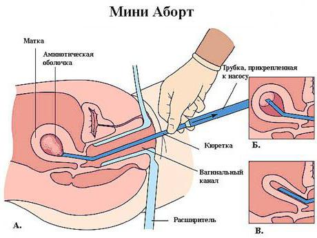 вакуумное прерывание беременности