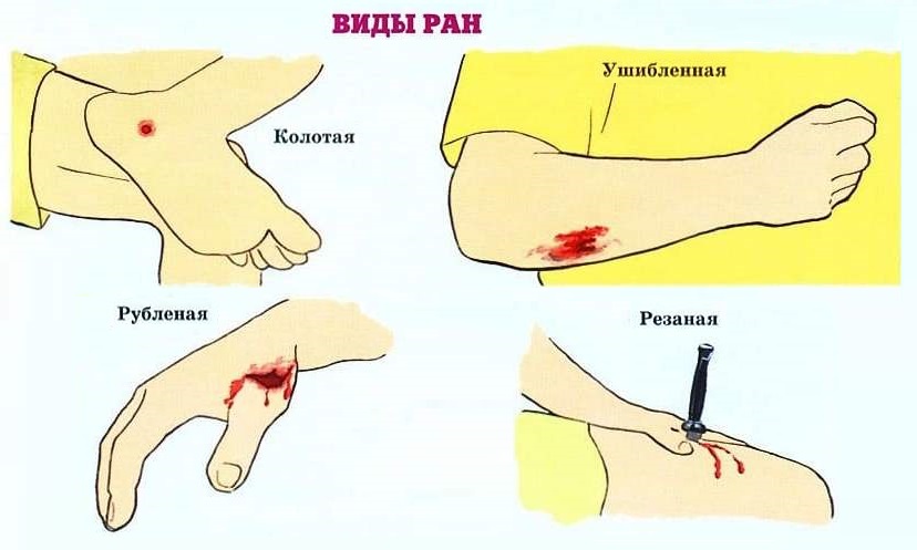 Виды ран и их описание Виды ран и их описание