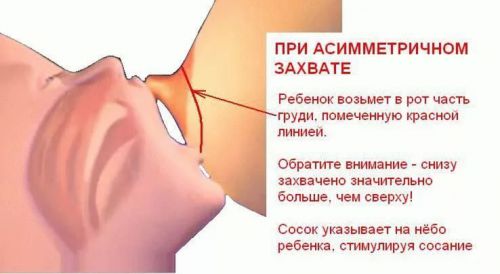 Асимметричный захват соска Асимметричный захват соска