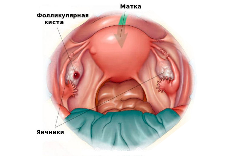 Фолликулярная киста яичника