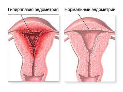 Гиперплазия эндометрия матки Гиперплазия эндометрия матки