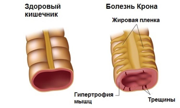 Болезнь Крона Болезнь Крона