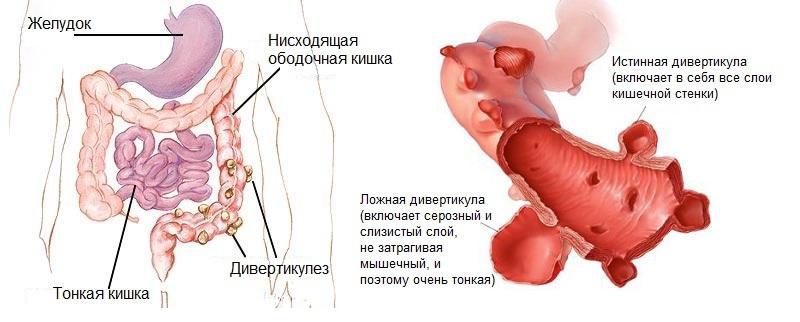 Дивертикулёз Дивертикулёз