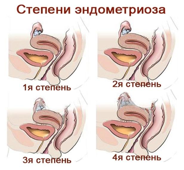 Эндометриоз Степени эндометриоза