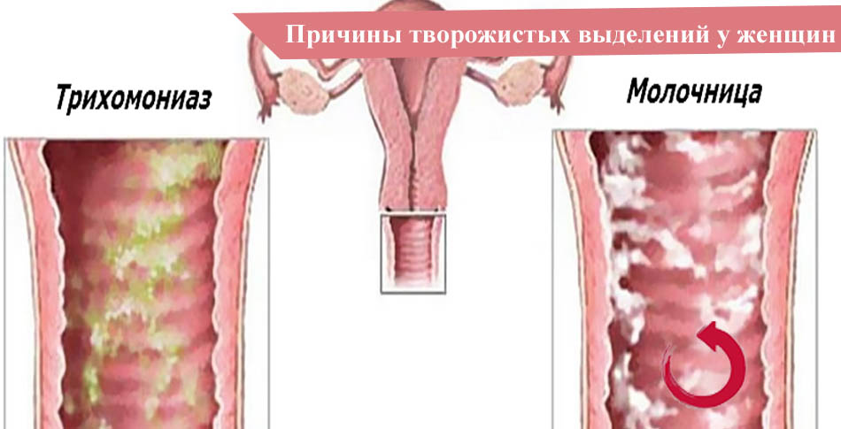 Причины появления творожистых выделений у женщины