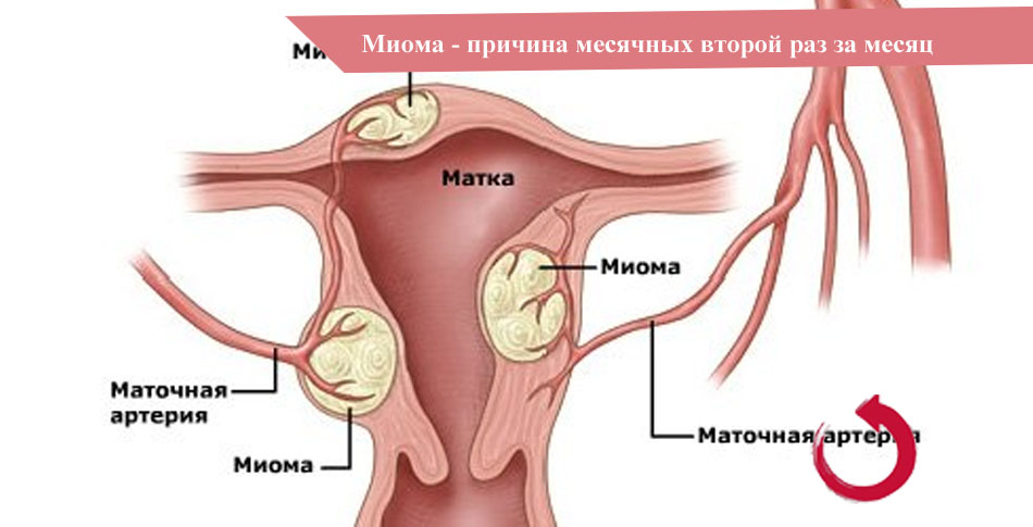 Месячные второй раз за месяц при миоме