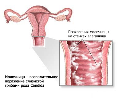 Что такое молочница