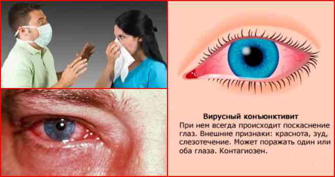 Вирусный конъюнктивит: профилактика и принципы лечения Вирусный конъюнктивит: профилактика и принципы лечения