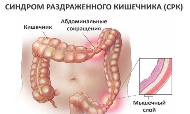 Синдром раздраженного кишечника