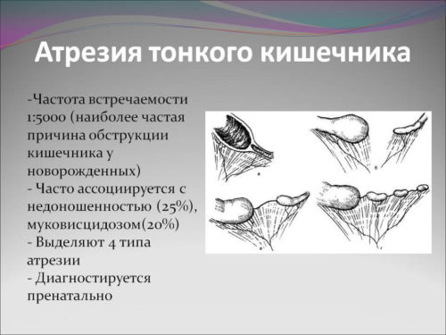 Обструкция кишечника у детей
