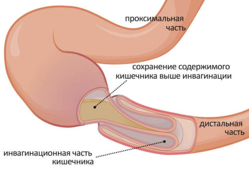 Распространённая врожденная непроходимость кишечника у детей