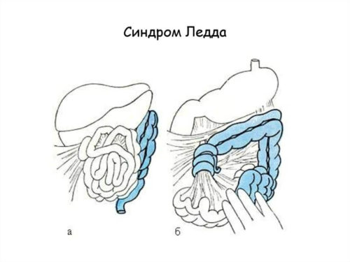 Врожденные патологии кишечника