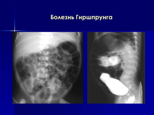 Причины запоров у новорождённых
