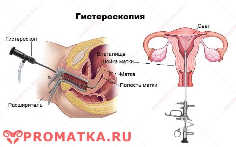 Как происходит гистероскопия Гистероскопия