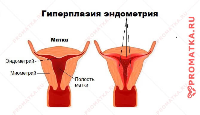 Гиперплазия эндометрия Как выглядит гиперплазия эндометрия
