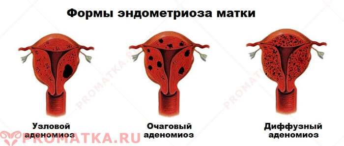 Формы аденомиоза Виды эндометриоза матки