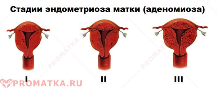 Степени аденомиоза Степени эндометриоза матки