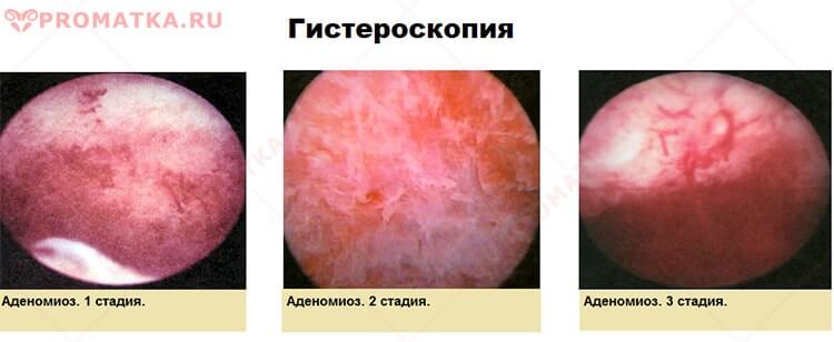 Диагностика аденомиоза Гистероскопия