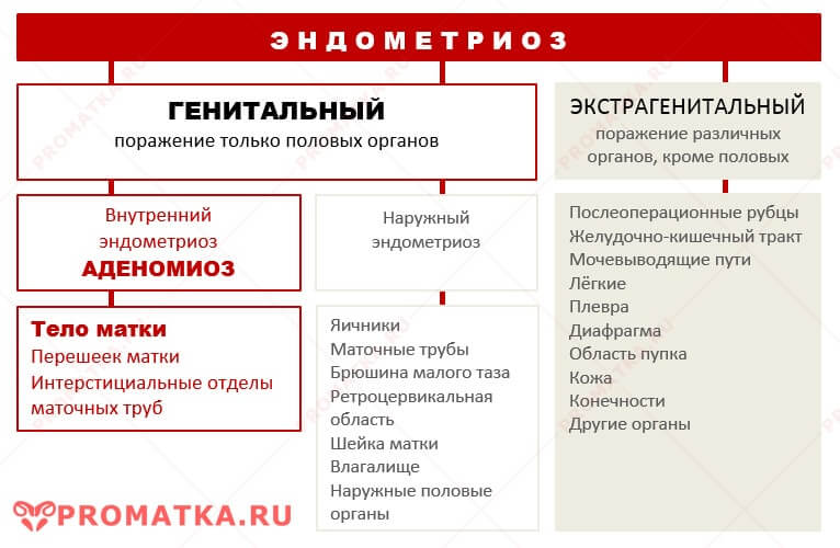 Структура эндометриоза Классификация эндометриоза