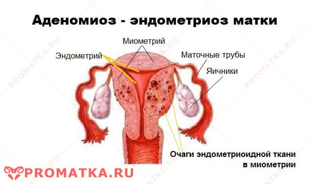 Аденомиоз Эндометриоз матки