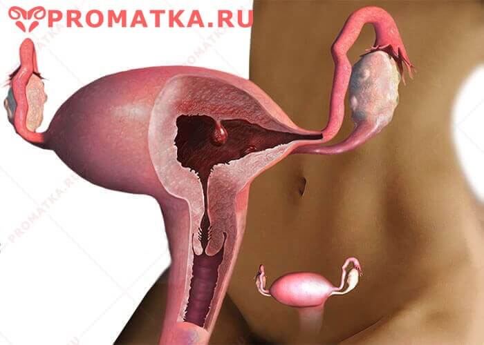 Полипы в матке и беременность Полипы эндометрия