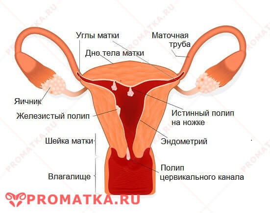 Полипы матки Полипы матки схема