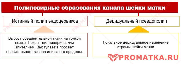Цервикальные полипы - схема Полипы шейки матки – схема