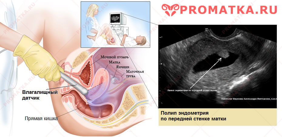 Как делают трансвагинальное УЗИ Полип эндометрия на УЗИ