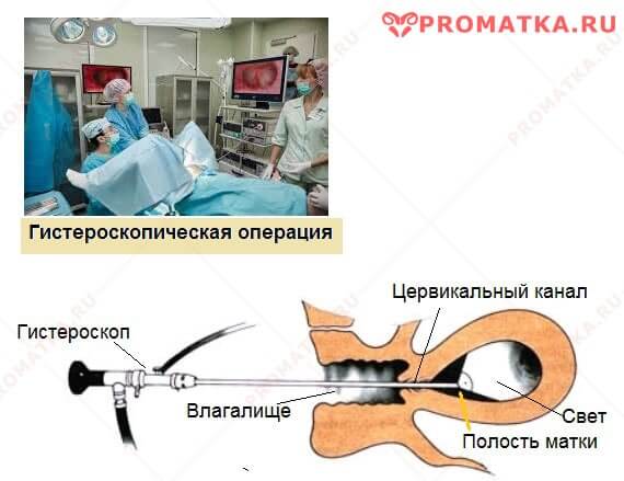 Гистероскопия полипа Гистероскопия – схема