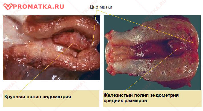Железистый полип внутри матки Полипы внутри матки