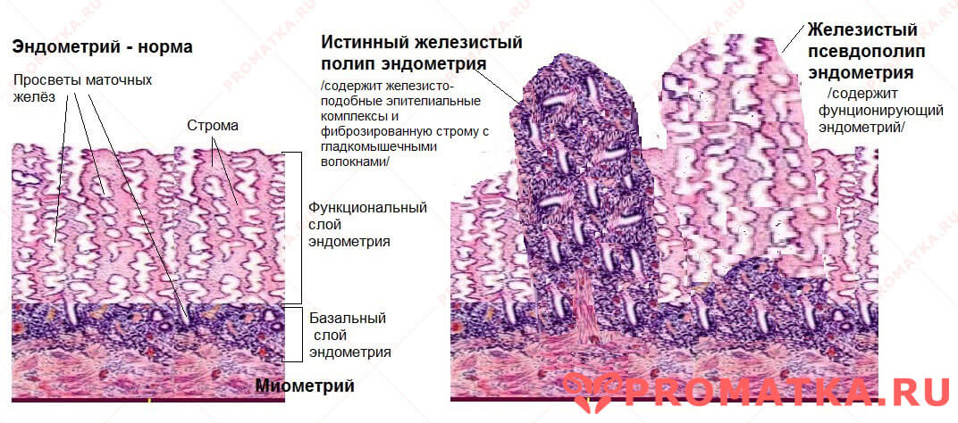 Эндометриальные полипы - схема Схема эндометрия и полипов