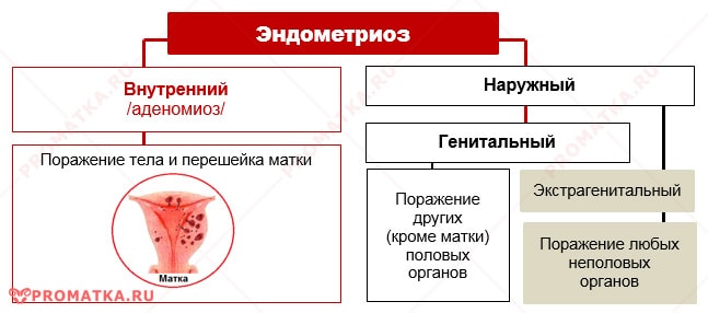 Эндометриоз – схема Классификация эндометриоза – схема