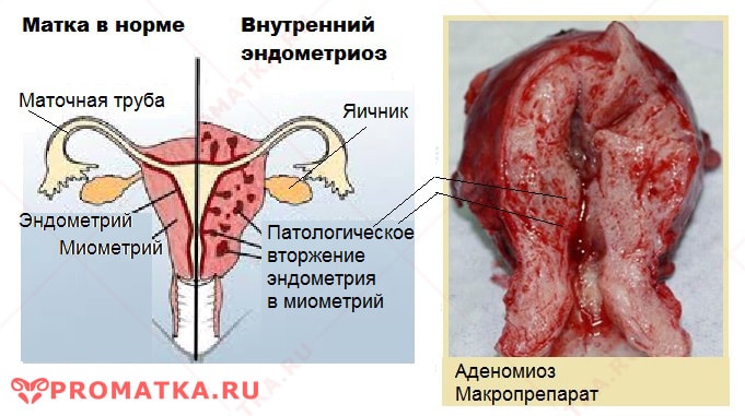 Аденомиоз - схема Внутренний эндометриоз - схема