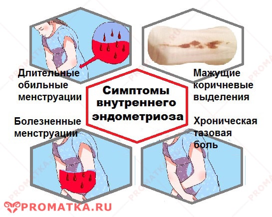 Признаки внутреннего эндометриоза Внутренний эндометриоз симптомы - схема