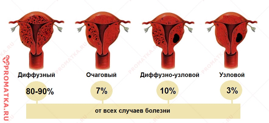 Формы аденомиоза – схема Формы внутреннего эндометриоза – схема