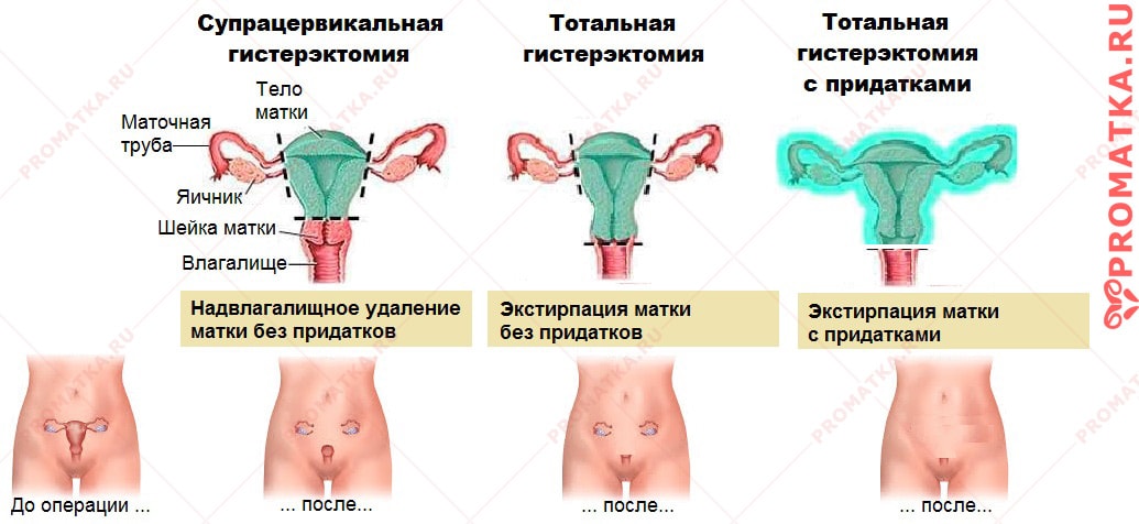Удаление матки – объём операции Виды гистерэктомии – схема.
