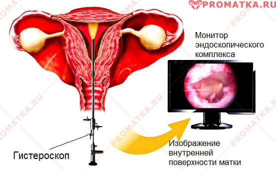 Диагностическая гистероскопия Гистероскопия эндометрия – схема