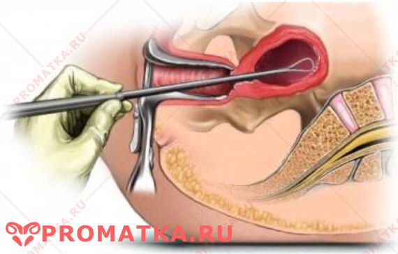 Кюретаж стенок матки Выскабливание эндометрия - схема