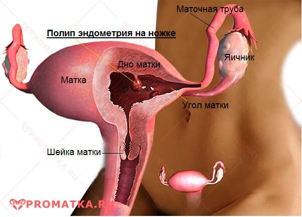 Полип тела матки Полип матки